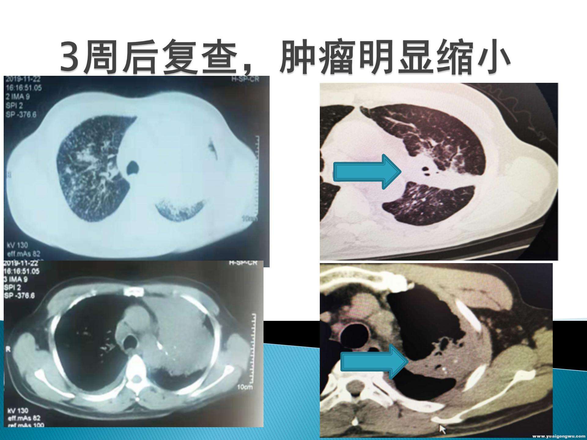 pd1病例讨论_18.jpg